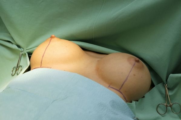 Implantáty značky PIP se nesmějí nadále používat.