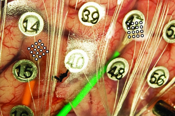 Velké (číslované) elektrody pro léčbu epilepsie a menší sítě šestnácti mikroelektrod.