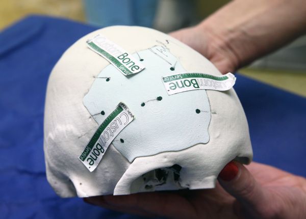 Poškozenou lebeční kost nově nahrazuje implantát, který se pomalu změní ve vlastní tkáň. Poškozenou lebeční kost nově nahrazuje implantát, který se pomalu změní ve vlastní tkáň.