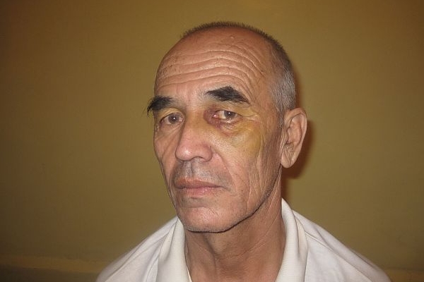 Azimžan Askarov s modřinou způsobenou represivními složkami. Azimžan Askarov s modřinou způsobenou represivními složkami.