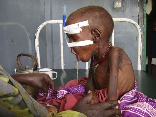 Pětiletý Abdiasis Jusúf. Nemocnice v Mogadišu mu s podvýživou stěží pomůže. Pětiletý Abdiasis Jusúf. Nemocnice v Mogadiše mu s podvýživou stěží pomůže.