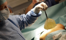 Vadný prsní implantát PIP má v Česku na dva tisíce žen.