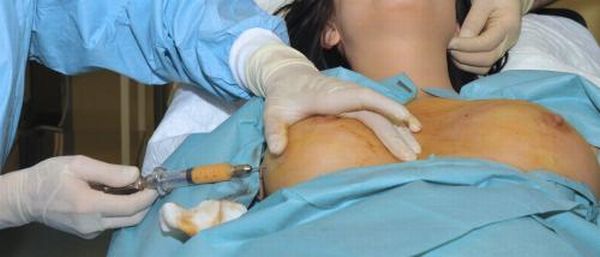 Výměnu prsních implantátů mají zaplatit nemocnice, tvrdí právník Ondřej Dostál.