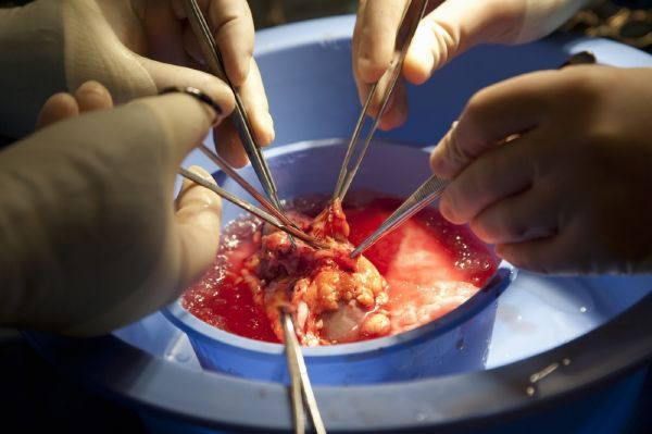 Ledvina připravovaná k transplantaci.