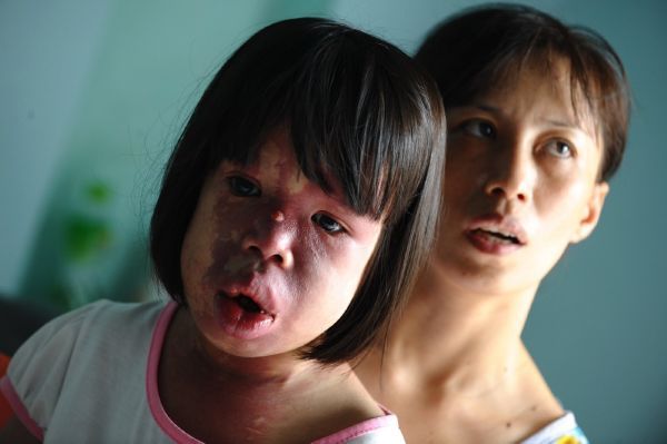 Ve Vietnamu se kvůli Agent Orange stále rodí zmrzačené děti.