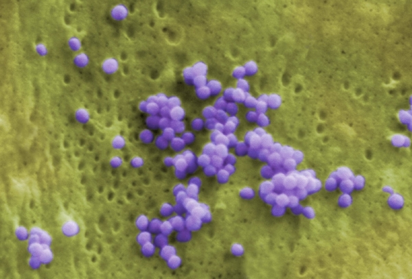 Virus HIV na infikované buňce.