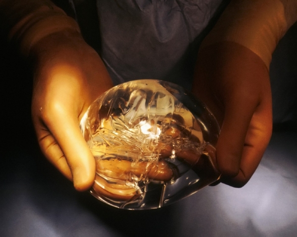 Implantáty si nechalo voperovat po celém světě asi 400 tisíc žen. Implantáty si nechalo voperovat po celém světě asi 400 tisíc žen.