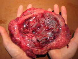 Placenta. Stačít z ní nadělat pilulky a už jen popřát dobrou chuť.