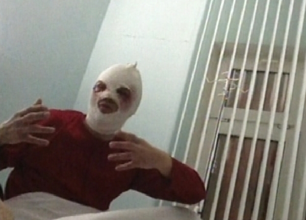Popálený Sergej Filin v nemocnici. Popálený Sergej Filin v nemocnici.