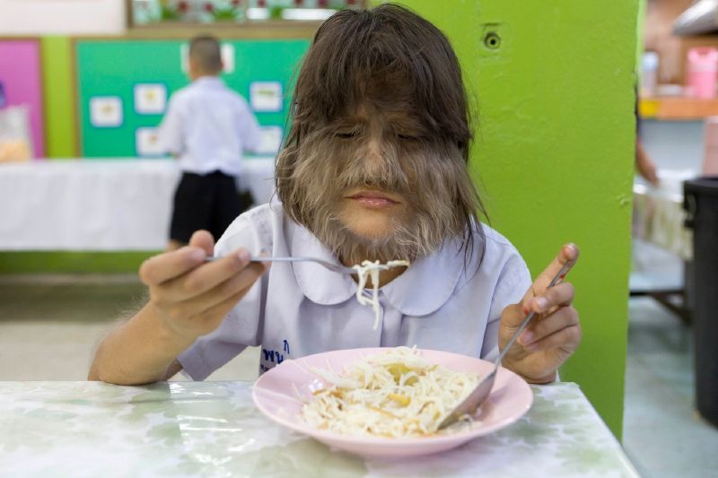 Vlkodlačí syndrom se projevuje nadměrným ochlupením po těle (ilustrační foto).