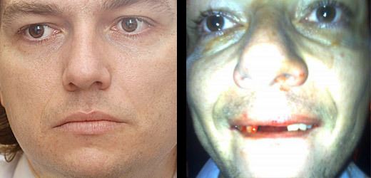 Babák přišel při potyčce o přední zuby.