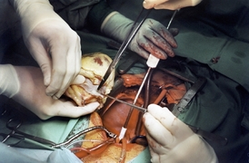 Transplantace orgánů.