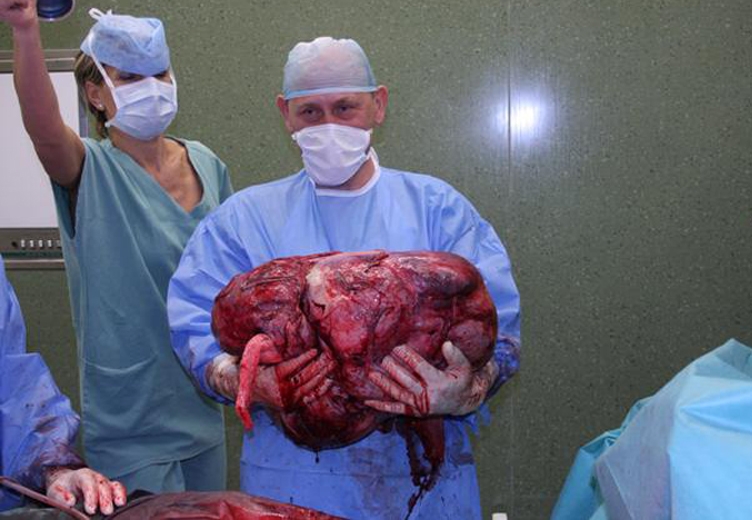 Lékaři ve zlínské nemocnici vyoperovali v polovině prosince z těla sedmačtyřicetileté pacientky zhoubný nádor o hnotnosti 36 kilogramů.