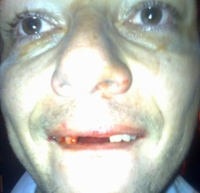 Babákův "rozbitý úsměv".