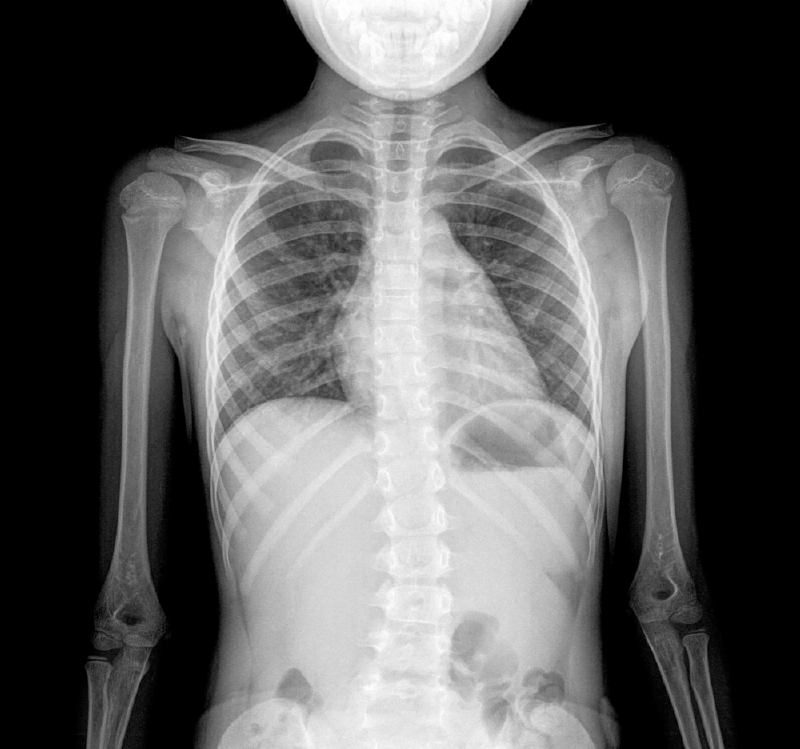 Stovky lidí umírá na rakovinu plic způsobenou radonem (ilustrační foto). Stovky lidí umírá na rakovinu plic způsobenou radonem (ilustrační foto).