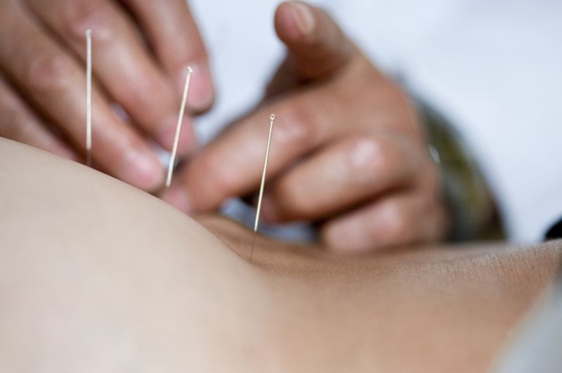 Mezi léčebné metody vycházející z tradiční čínské medicíny patří i akupunktura.