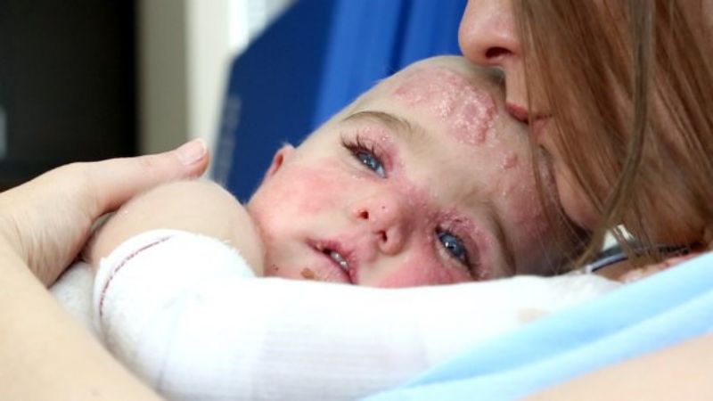 Dítě trpící "nemocí motýlích křídel". Dítě trpící "nemocí motýlích křídel".