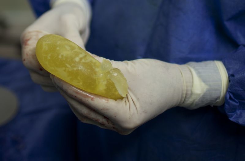Vadné prsní implantáty si pořídilo okolo 300 tisíc žen (ilustrační foto).