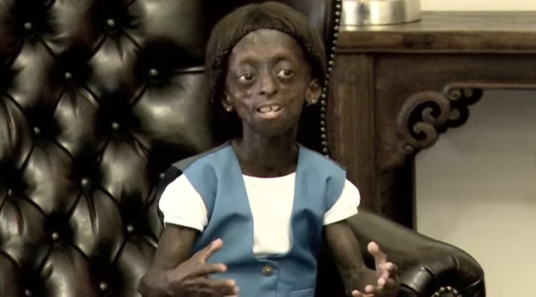 Ontlametse Phalatseová se syndromem předčasného stárnutí zemřela.