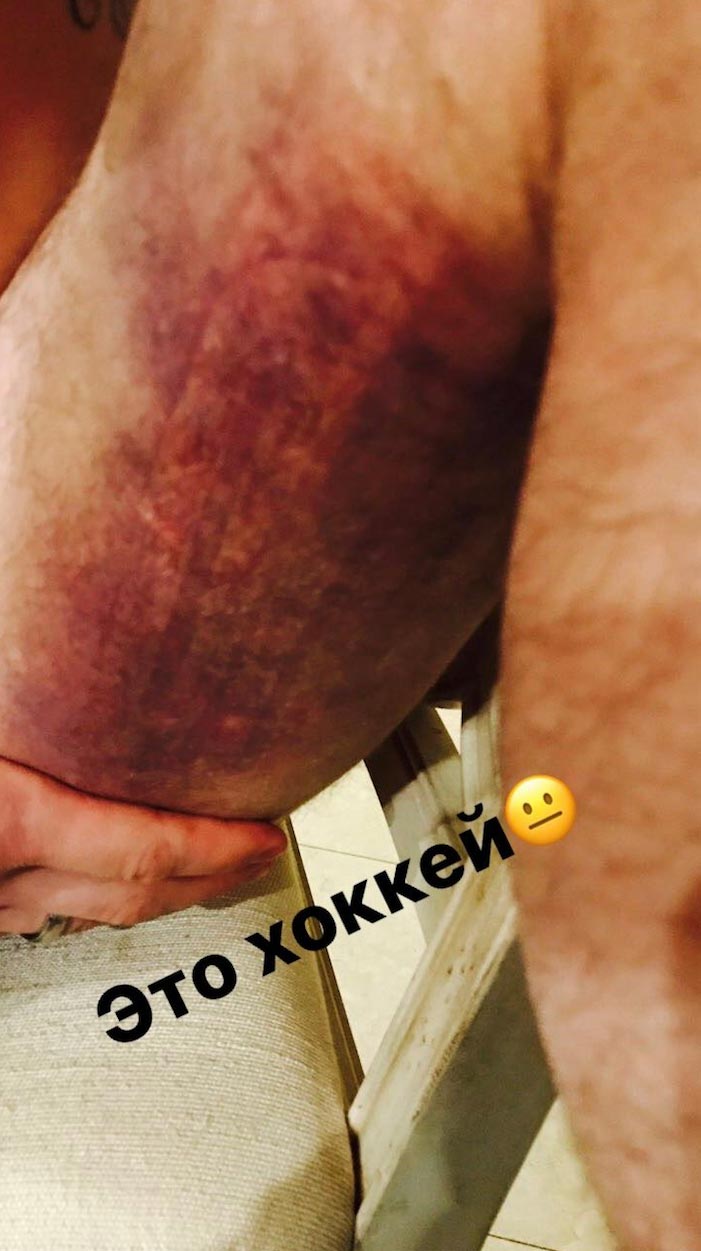 Zraněná noha Alexandera Ovečkina. Zraněná noha Alexandera Ovečkina.