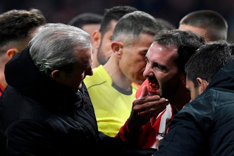 Diego Godín přišel v zápase španělské ligy o několik zubů. Diego Godín přišel v zápase španělské ligy o několik zubů.