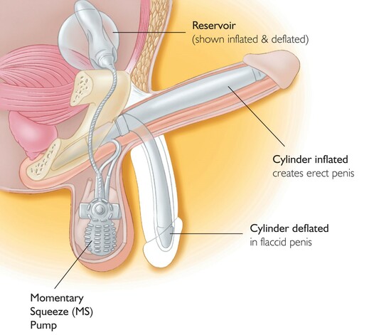 Implantát.