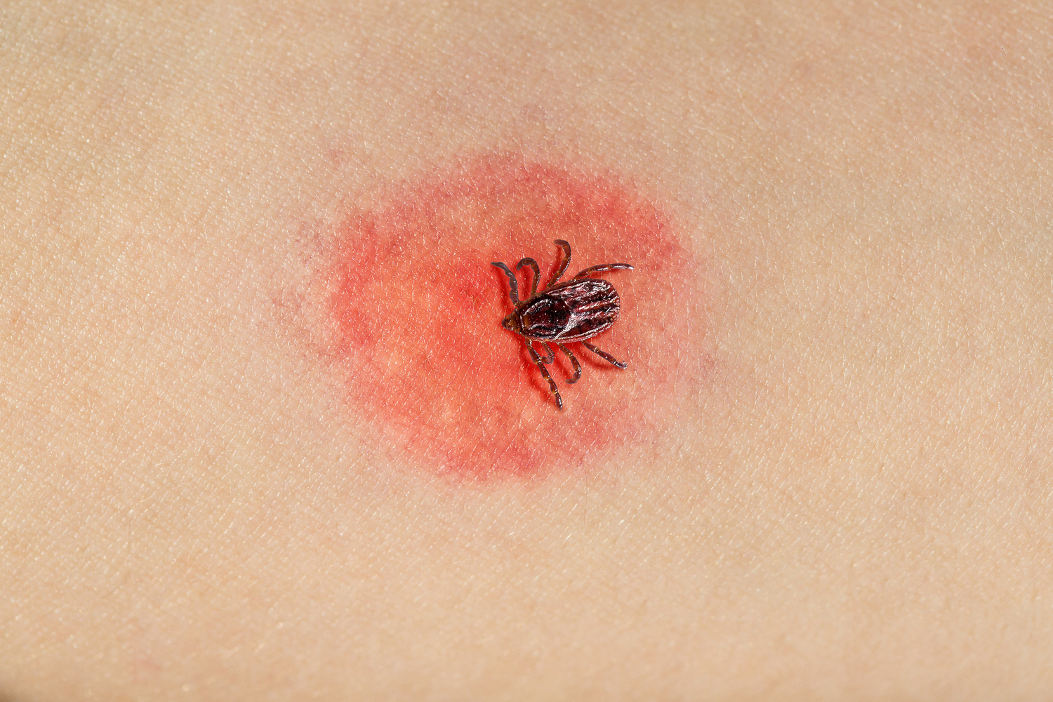  Jihomoravští hygienici evidují více případů klíšťové encefalitidy i boreliózy