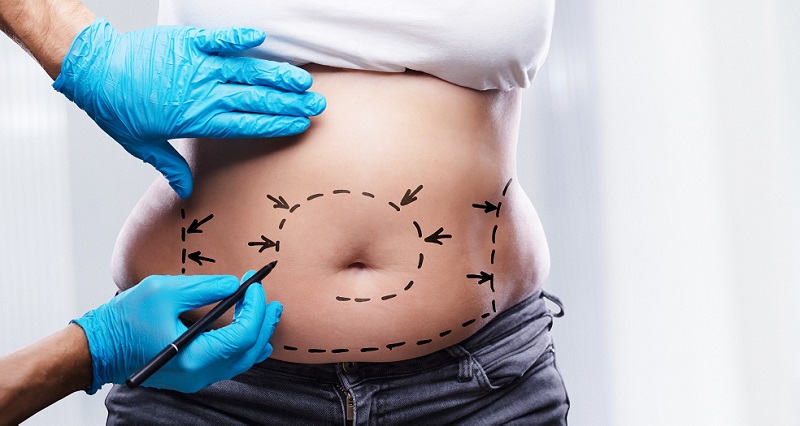 Liposukce je invazivní estetický zákrok, při němž dochází k odstranění nadbytečného tuku z určitých tělesných partií.