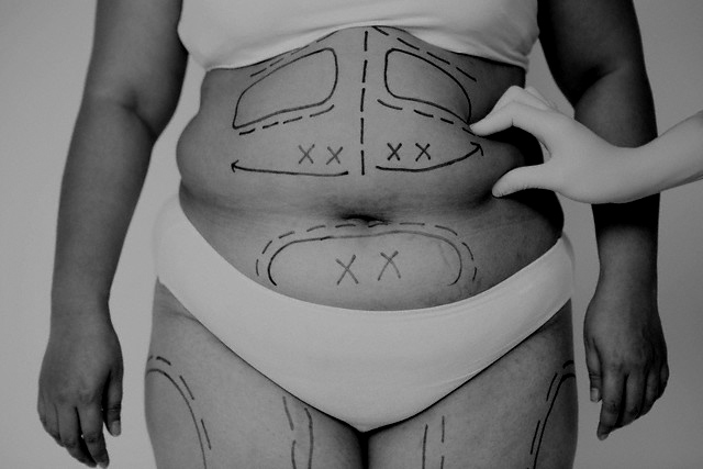 Liposukce (ilustrační foto). Liposukce (ilustrační foto).