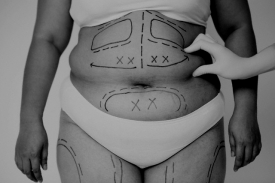 Liposukce (ilustračn&iacute; foto).