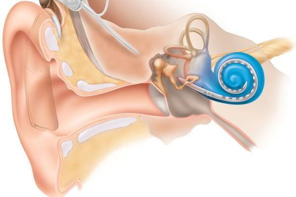Elektrody kochleárního implantátu přímo stimulují sluchový nerv.