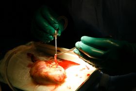 Filip&iacute;ny coby meta transplantac&iacute; ledvin konč&iacute;.